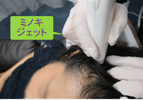 女性の薄毛には育毛剤よりもミノキシジル まずは無料カウンセリングを 元気に老いるため今日も頑張ってます